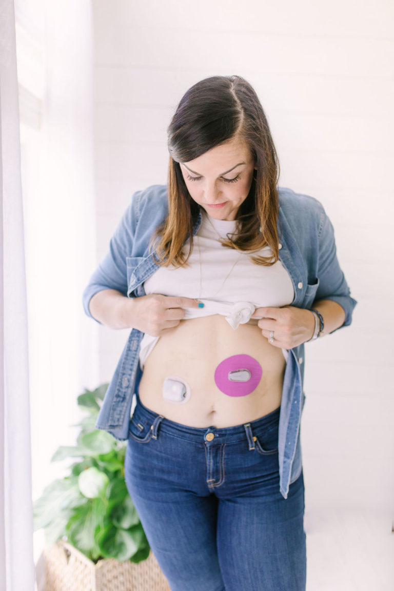 woman with diabetes wearing insulin pump and dexcom