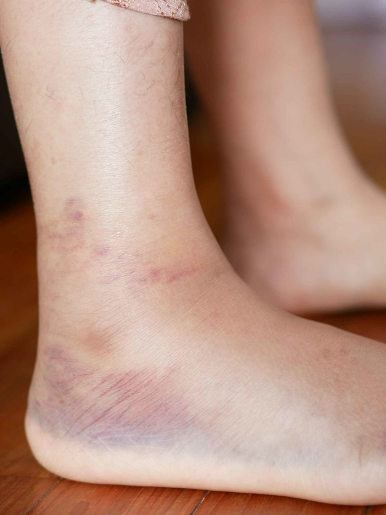 Signs of Early Diabetes Feet for Women and Men Milk Honey Nutrition