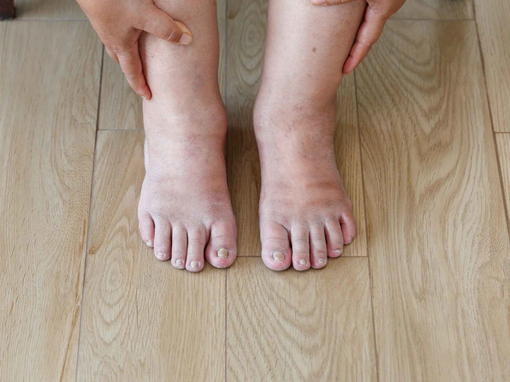 swollen feet from early diabetes feet
